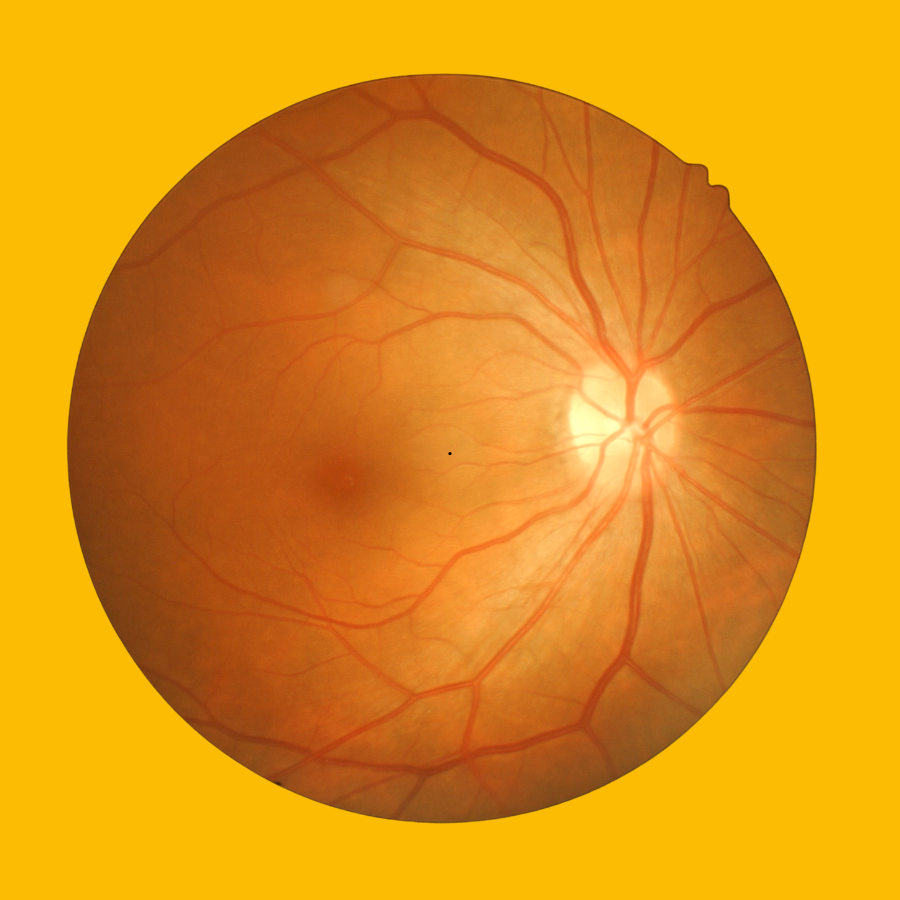 Retinal Optos imaging for early eye disease detection